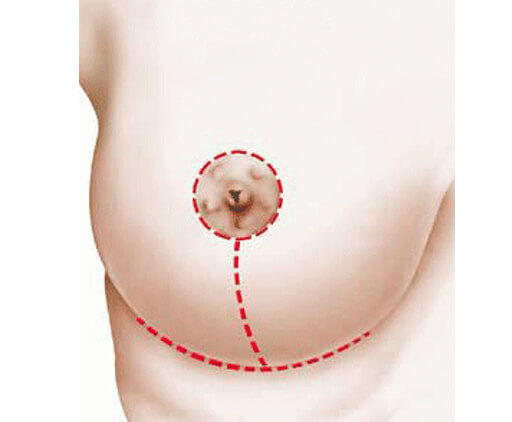 lipofilling mammaire en Tunisie avis