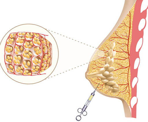 lipofilling mammaire en Tunisie